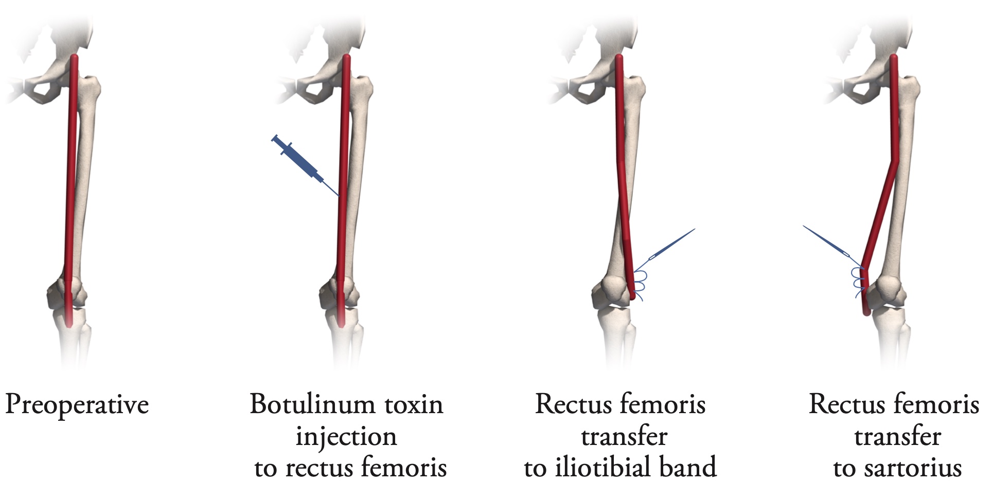 11.7-botulinum-toxin-injection-surgery-physical-therapy-braces