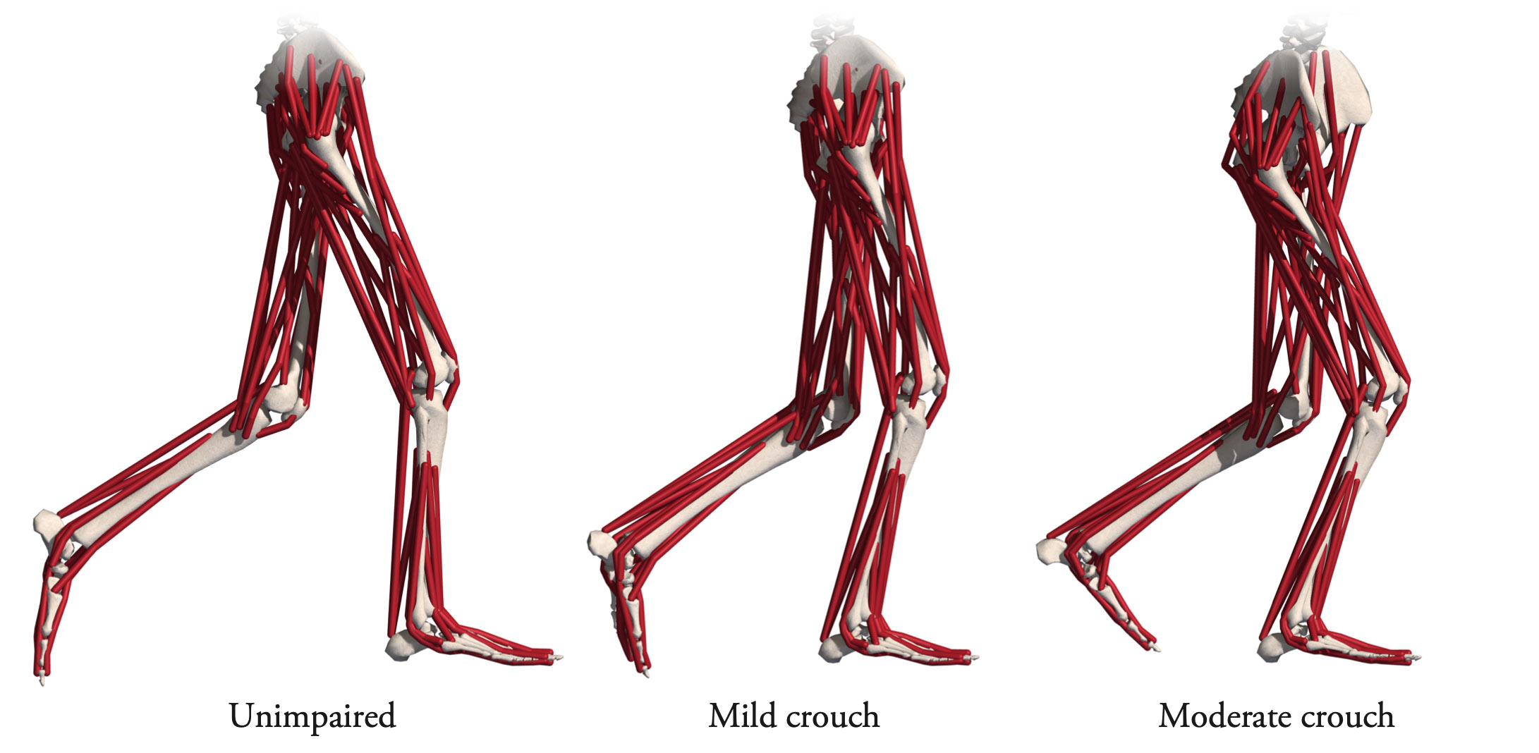 Crouch gait